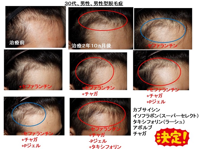 円形脱毛症　病院